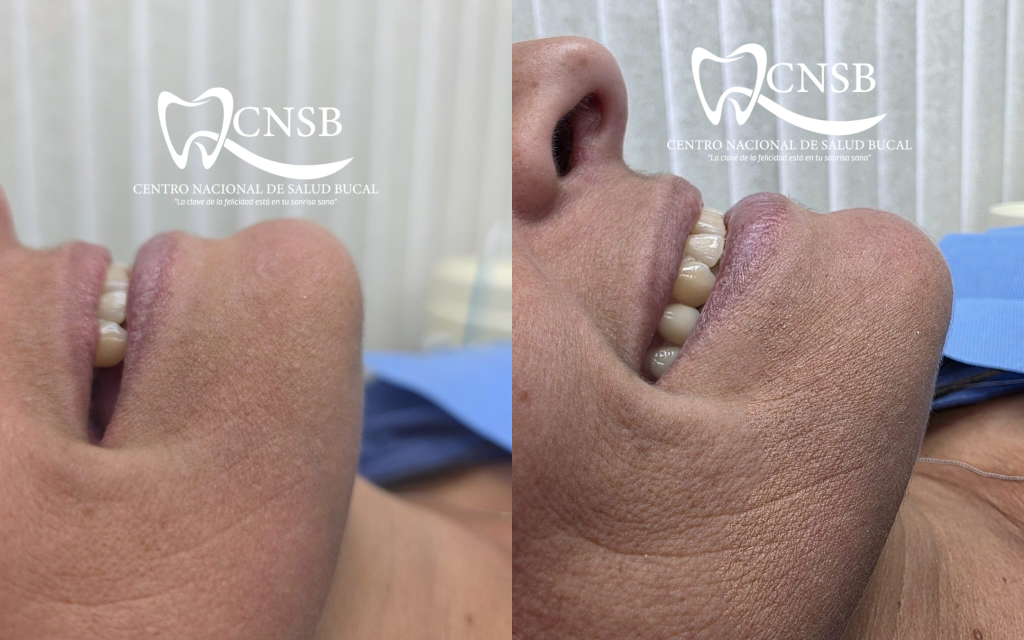 Resultado de Rehabilitación Oral